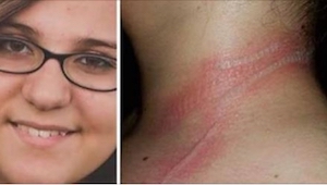 En pige på tretten år fik brandsår på kroppen, fordi… hun brugte sin mobil på en