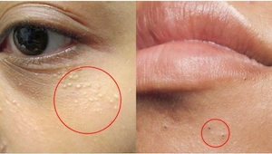 4 forskellige typer ændringer af huden, som man under ingen omstændigheder må rø