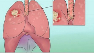  Lungekræft, som opdages i tide, kan helbredes! Se her, hvilke symptomer, du ska