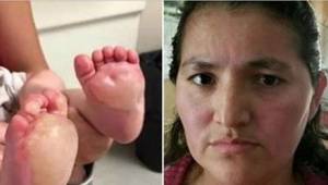 Moderen så store blærer på hendes babys fødder. Lægerne fortalte hende den choke