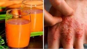 7 metoder mod psoriasis – kæmp for en sund hud, uden at behøve forlade hjemmet.